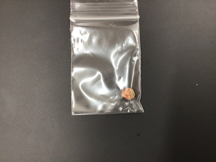 取り出した結石